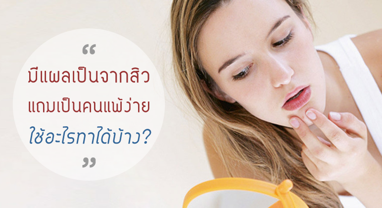 มีแผลเป็นจากสิว แถมผิวแพ้ง่าย ใช้อะไรทาได้บ้าง ?