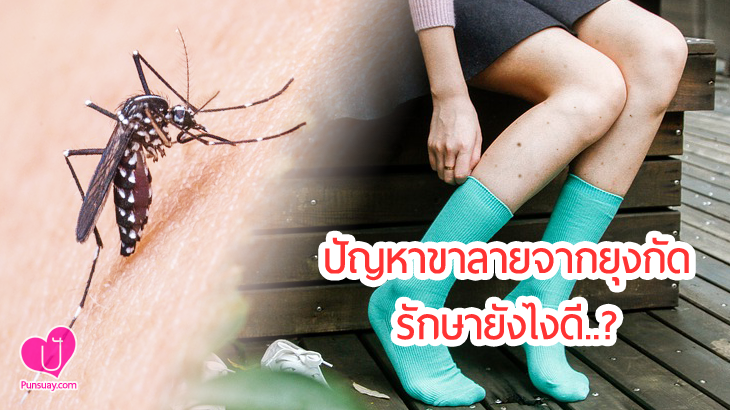 ปัญหา “ขาลาย” จากยุงกัด รักษายังไงดีคะ ?