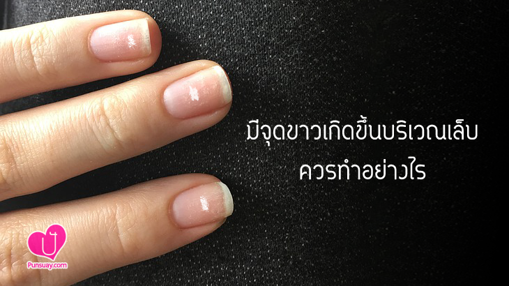 มีจุดขาวเกิดขึ้นบริเวณเล็บควรทำอย่างไร..?