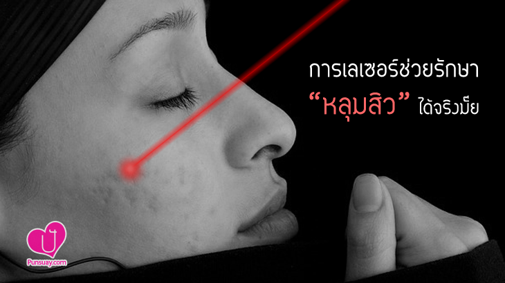 “การทำเลเซอร์” ช่วยรักษาหลุมสิวได้จริงมั๊ย ?