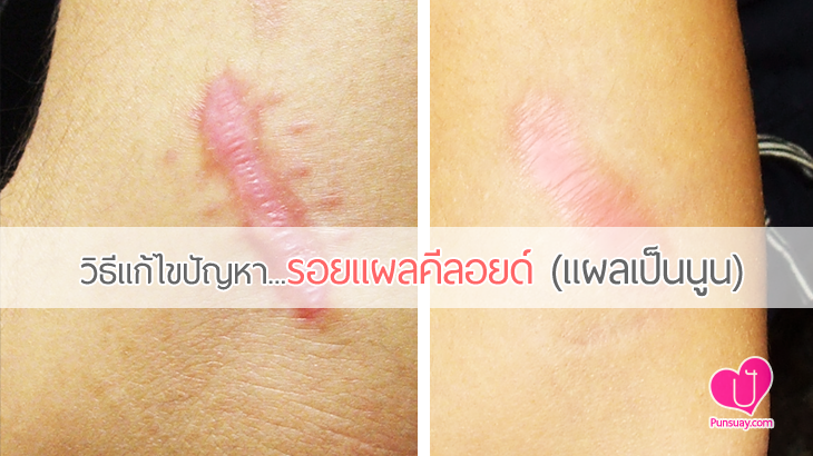 วิธีแก้ไขปัญหารอ “ลอยแผลคีลอยด์ ” (แผลเป็นนูน)